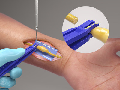 Checkpoint Surgical announced today the launch of the Checkpoint Edge™ Nerve Cutting Kit, extending the breadth of the company’s intraoperative nerve care portfolio.