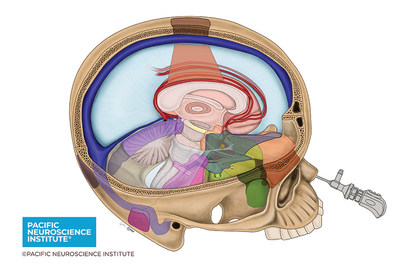A composite drawing depicting six "keyhole" surgery approaches for meningioma removal: endonasal, supraorbital, minipterional, retromastoid, suboccipital sitting gravity-assisted and transfalcine gravity-assisted. © 2022 Pacific Neuroscience Institute
