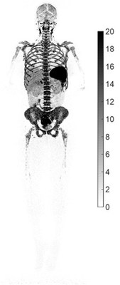 The first reported image of CD8+ T cell distribution in a recovered COVID-19 patient (F, 29 y/o, BMI 29), imaged 7 weeks post symptom onset on the uEXPLORER total-body PET/CT scanner, using a ~0.5 mCi injected dose of 89Zr-Df-Crefmirlimab-Berdoxam. Lymphoid organs containing CD8+ T cells (such as spleen, bone marrow, lymph nodes, and tonsils) showed the largest uptake, reflected by the darker black parts of the image. Image courtesy of Dr. Negar Omidvari at UC Davis.