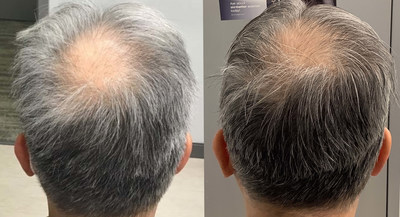 Before and After 4 TED Treatments
[Courtesy: Dr. L. Dy]