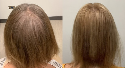Before and After 2 TED Treatments
[Courtesy: Dr. L. Dy]