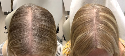 Before and After 2 TED Treatments:
[Courtesy: Dr. L. Dy]