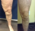 Fox Vein &amp; Laser Experts Seeing Increased Volume of Men in Last 12 Months Seeking Treatment for Varicose Veins and Venous Insufficiency