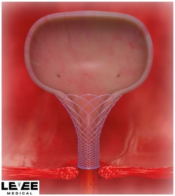 The Voro™ Urologic Scaffold