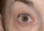 Is that Just a "Lump or Bump" on Your Eyelid or Is It a Cancerous Lesion or Cyst? Trust an Ophthalmologist - A Medical Eye Surgeon- for the Diagnosis and Treatment