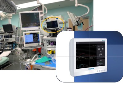 SentiCor-100 - continuous non-Invasive blood pressure monitoring system