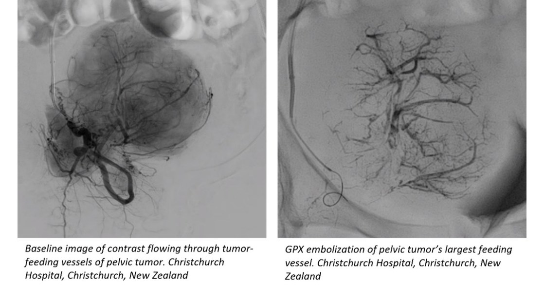 New Liquid Embolic Multi-Center Trial Successfully Enrolls Final Patient