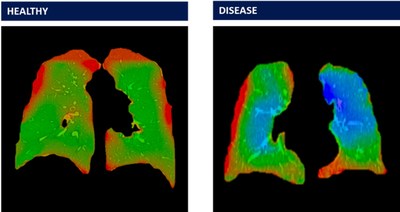 Attachments: Lung scans depicting healthy/control subjects and lungs of a Veteran with biopsy confirmed constrictive bronchiolitis as processed by 4DMedical XV LVAS Software.

Single slices of 4DMedical XV scans from the Vanderbilt ?burn pit' clinical trial (left) from a healthy/control subject and (right) from a veteran exposed to burn pits with biopsy confirmed constrictive bronchiolitis. The image on the left visualises principally as green representing average levels of ventilation, while the image on the right shows significant regions of both red (low) and blue (high) ventilation. In addition to the visualisations shown here, additional quantitative scores and assessments identify the differences between veterans with constrictive bronchiolitis and healthy controls.