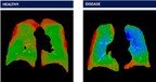 Vanderbilt Completes Study Evaluating Advanced, Four-Dimensional Lung Imaging Software from 4DMedical