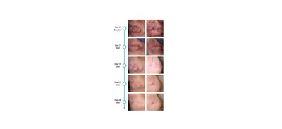 Figure 1: Image of the irradiated area of a patient in part 1 of the study at baseline and at each visit (1 week intervals). Courtesy of Lutris Pharma. 