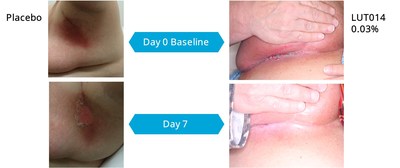 Figure 2: Images of 2 patients in part 2 of the study after 1 week of treatment. On the left is a patient in the placebo arm. On the right is a patient treated with LUT014. Courtesy of Lutris Pharma.