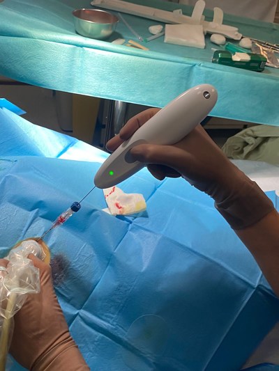 Kronos Device cauterizing during a liver biopsy procedure