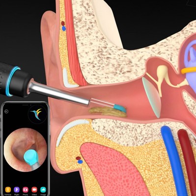 Bebird's ear cleaning systems are engineered to provide you with a seamless live feed of your ear canal directly on your Apple or Android device.