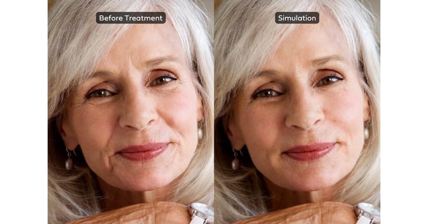 BeautyFix Medspa Launches The FIRST Ever Medically Accurate AI Aesthetics Simulation for Injectables BeautyFix Medspa Launches The FIRST Ever Medically Accurate AI Aesthetics Simulation for Injectables
