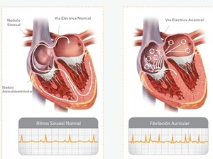 La arritmia cardiaca más frecuente en México, Fibrilación Auricular (FA), afecta a más de medio millón de personas[1]