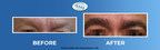 BODY HAIR TRANSPLANTATION REMAINS POPULAR, EFFECTIVE WAY TO PERMANENTLY RESTORE SPARSE FACIAL AND BODY HAIR