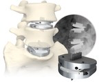 Study Featured at NASS 2022 Demonstrates Long-Term Effectiveness of Centinel Spine's prodisc® L Total Disc Replacement