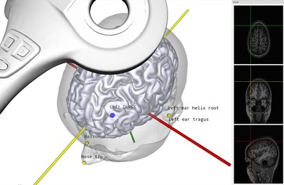 Soterix Medical parcel-guided targeting solution to be integrated with existing FDA cleared navigation system upon successful clinical trial outcome.