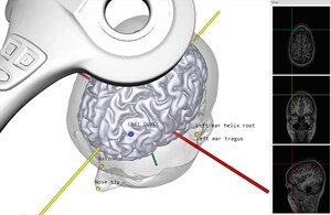 Soterix Medical Announces award of Fast Track NIH grant to develop a Parcel-Guided software to improve efficacy of rTMS treatment for Depression