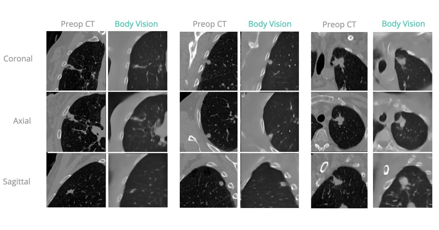 Body Vision Medical Announces AI Tomography Intraoperative CT Imaging for GE's OEC Line of C-arms