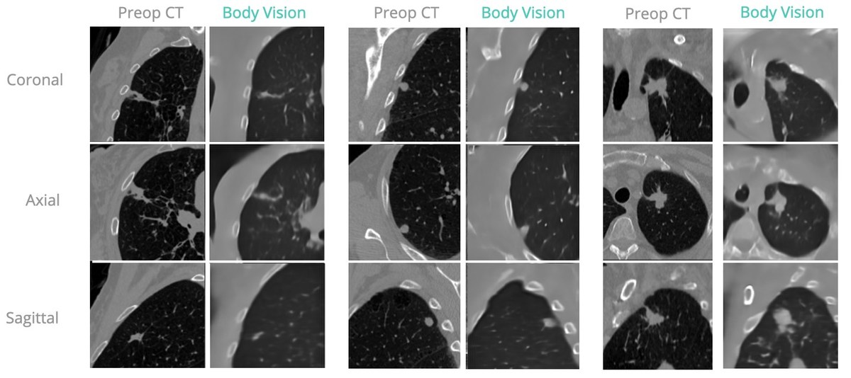Body Vision Medical Announces AI Tomography Intraoperative CT Imaging for GE's OEC Line of C-arms - Vimarsana News