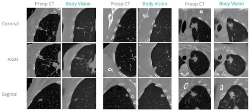 Paired images showing preoperative CT with corresponding Body Vision AI Tomography intraoperative CT scan with GE OEC Elite CFD (left) and GE OEC 9900 Elite (middle and right) C-arms. Paired images showing preoperative CT with corresponding Body Vision AI Tomography intraoperative CT scan with GE OEC Elite CFD (left) and GE OEC 9900 Elite (middle and right) C-arms.