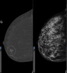 American College of Radiology (ACR) launches Contrast-Enhanced Mammography Imaging Screening Trial (CMIST) in collaboration with GE Healthcare and the Breast Cancer Research Foundation