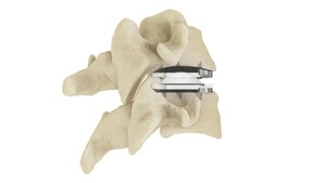 Centinel Spine Announces 100th Procedure with prodisc® C Vivo Cervical Total Disc Replacement Product