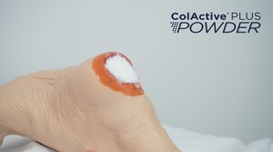 Closing Chronic Wounds with Collagen Powder: University of Michigan case study demonstrates the efficacy of ColActive Plus Powder in resolving non-healing wounds
