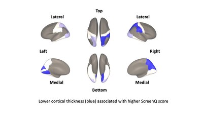 Areas in blue represent brain areas affected by high digital media usage among 3- to 5-year-olds, according to new research from experts at Cincinnati Children's.