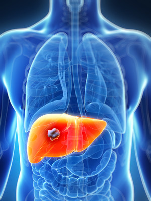 The liver cancer mortality rate has risen steadily over decades, making it the sixth leading cancer killer in the United States and the third-leading cause of cancer-related deaths worldwide.