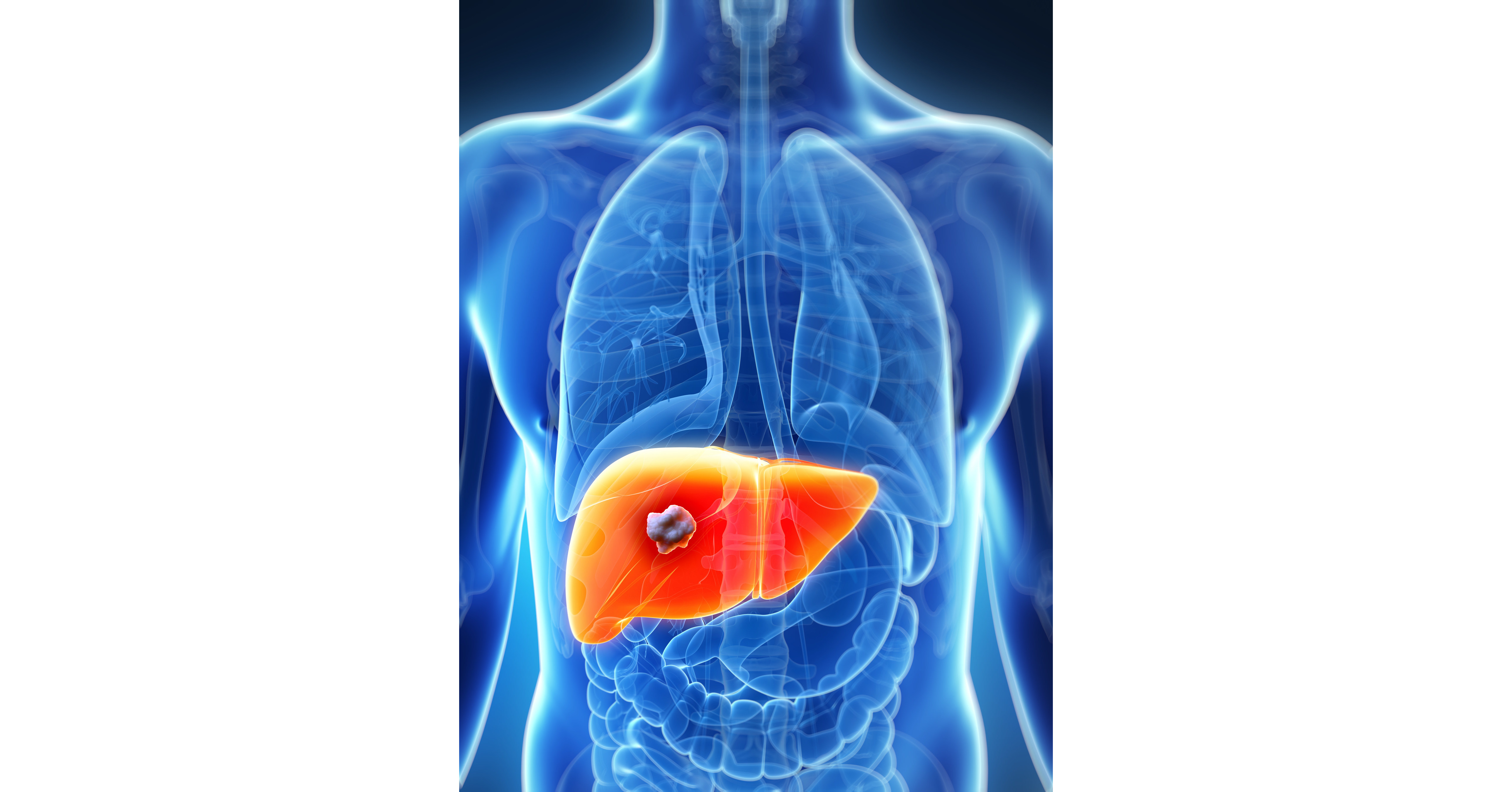 Positive Liver Cancer Detection Data Published in Cancer Discovery Shows  Further Promise of Delfi's AI Liquid Biopsy Platform