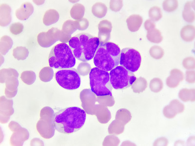 Acute myeloid leukemia (AML) is a cancer of the blood and bone marrow — the spongy tissue inside bones where blood cells are made.