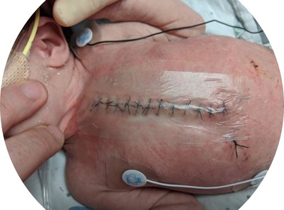 SurgiClear® protecting a cardiac surgical incision on a newborn baby. (CNW Group/Covalon Technologies Ltd.)