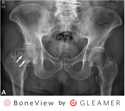 BoneView by GLEAMER enables faster and more accurate film reading