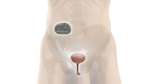 UroMems, a global company developing breakthrough, mechatronics technology to treat stress urinary incontinence (SUI), announced today that it has successfully completed the first-in-human implant of the UroActive™ System, the first smart automated artificial urinary sphincter (AUS) investigational device to treat SUI. This initial clinical study is a key milestone in the development of UroActive.