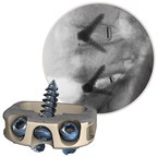New Publication Supports Clinical Effectiveness of Centinel Spine's Stand-Alone STALIF® M Integrated Interbody™ Portfolio