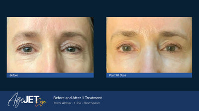Female Patient After One AgeJET Eye Treatment