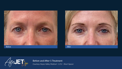 Female Patient After One AgeJET Eye Treatment