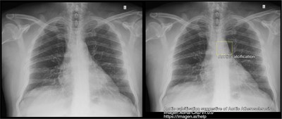 Figure 1: Left shows a chest radiograph. Right shows the output of FDA cleared software, Aorta-CAD on the same chest radiograph. The software is identifying and highlighting aortic calcifications as suggestive of Aortic Atherosclerosis.