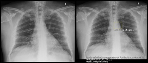Figure 1: Left shows a chest radiograph. Right shows the output of FDA cleared software, Aorta-CAD on the same chest radiograph. The software is identifying and highlighting aortic calcifications as suggestive of Aortic Atherosclerosis. Figure 1: Left shows a chest radiograph. Right shows the output of FDA cleared software, Aorta-CAD on the same chest radiograph. The software is identifying and highlighting aortic calcifications as suggestive of Aortic Atherosclerosis.