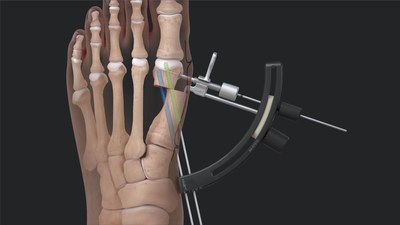 Arthrex Innovates Bunion Correction With Minimally Invasive Procedure