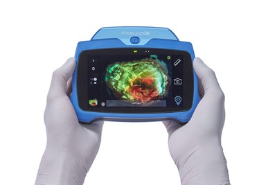 The MolecuLightDX™ point-of-care imaging device detects elevated bacterial loads in wounds to help clinicians prevent surgical site complications.  (CNW Group/MolecuLight)