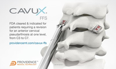 CAVUX FFS is a unique surgical implant constructed of a CAVUX Cervical Cage and an ALLY Bone Screw. Two FFS devices are implanted bilaterally through the back of the neck and span the facet joint to provide immobilization and stabilization as an adjunct to posterior cervical fusion.