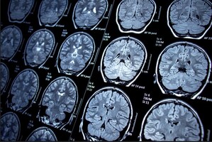 Magnetic Resonance Imaging Market to Witness Growth Due to The Increasing Demand for Scans