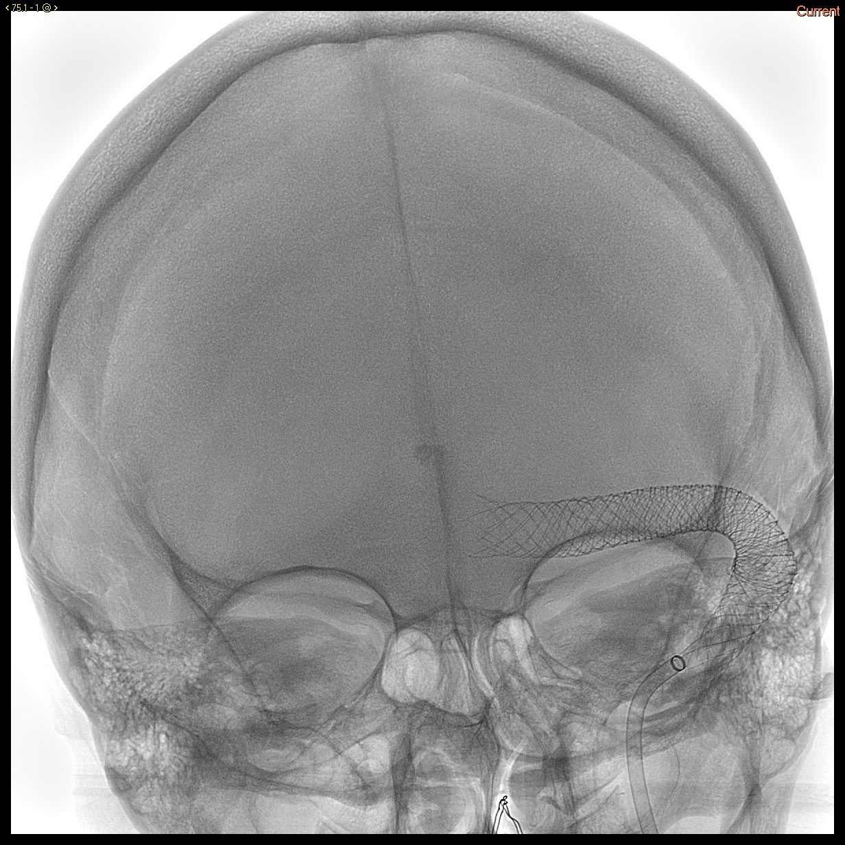 Sonorous NV Uses New Device to Treat Patients with Symptomatic Cerebral Venous Diseases