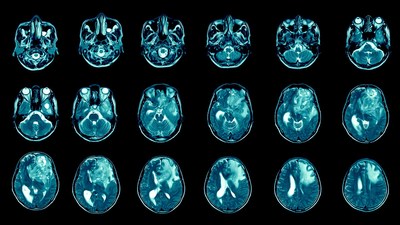 A series of brain MRIs from a glioblastoma patient with a tumor in the left frontal lobe. New research from Cold Spring Harbor Laboratory reveals an unprecedented therapeutic strategy for battling this aggressive cancer. Image: © Richman Photo – stock.adobe.com