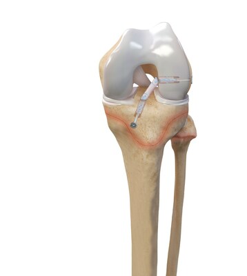 Arthrex All-Epiphyseal Quad Tendon ACL Reconstruction with the FiberTag® TightRope® Implant