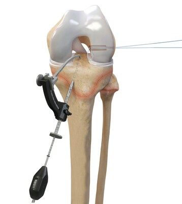The Arthrex FlipCutter III drill and all-epiphyseal RetroConstructiontm guide system were designed to aid surgeons in treating patients with open physes