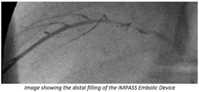 Image showing the distal filling of the IMPASS Embolic Device